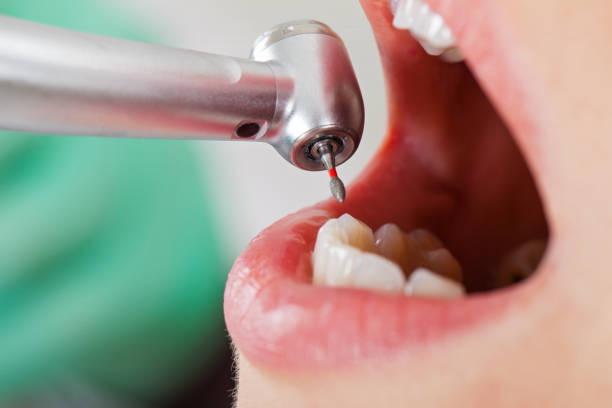 Best Emergency Root Canal Treatment in Monticello, GA